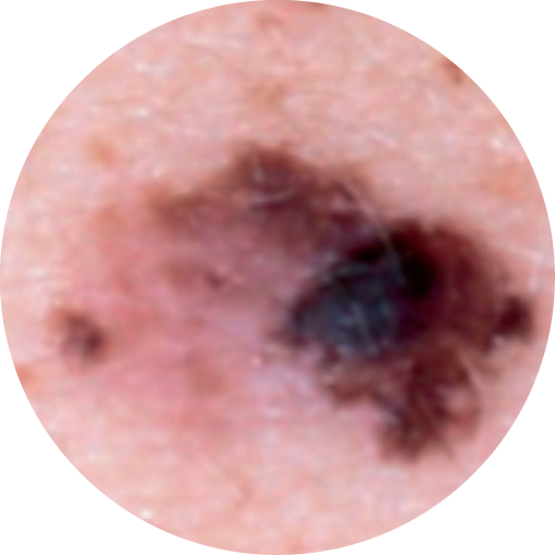 A=ASYMMETRY:When half the mole doesn't match the other