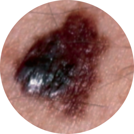 C=COLOUR:When the colour of the mole varies throughout and/or there appears to be no uniform pigmentation