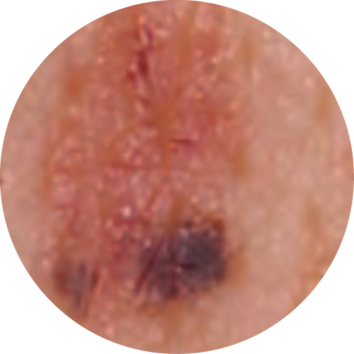 E=EVOLVING:Changes in the mole over a variable time, weeks, months, years